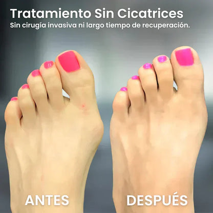 Compra uno y llévate otro gratis. 2x1 - CORRECTOR ORTOPRO™ DE JUANETES - RESULTADOS EN UN MÊS + ENVÍO GRATIS ✈️
